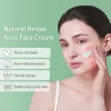 JOYPRETTY Herbal Acne Cream - Image 2